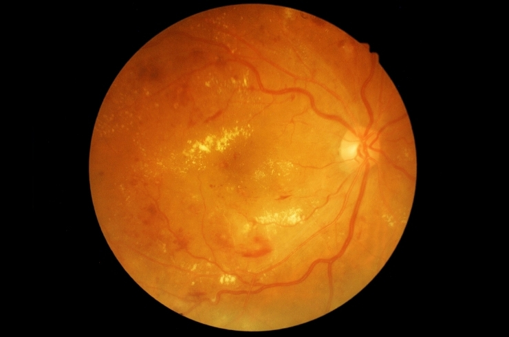 Retina And Lens Lab